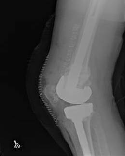 Periprosthetic TKR Locking Plate Nonunion 6